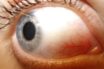 are our eyes susceptible to sars-cov-19