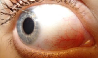 are our eyes susceptible to sars-cov-19
