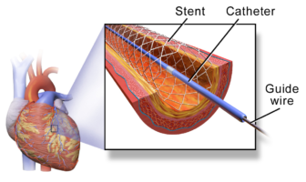 hypertension and covid-19 symptoms