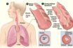 link between asthma and covid-19 severity