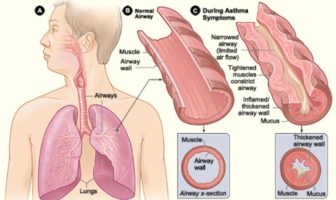 link between asthma and covid-19 severity