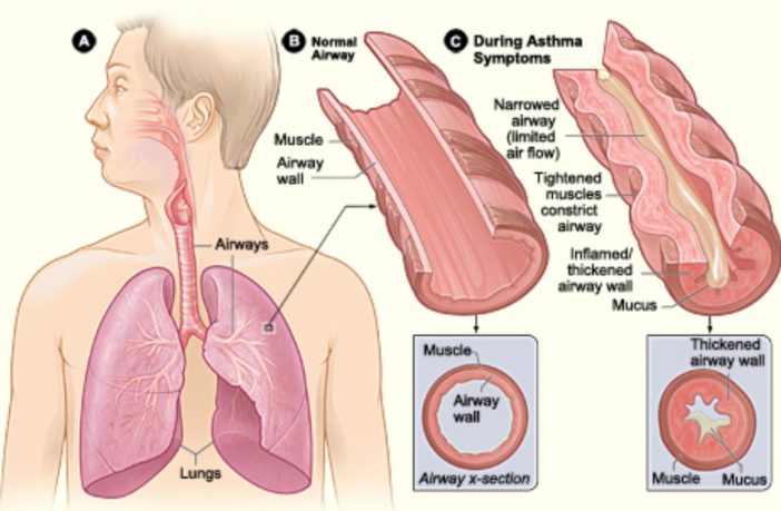 link between asthma and covid-19 severity