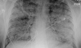 how would we know if we had covid-19