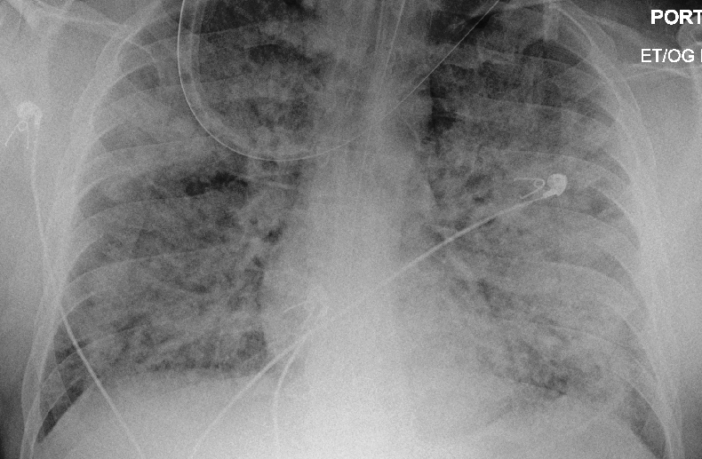 how would we know if we had covid-19