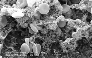 the astra-zeneca blood clots