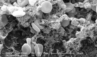 the astra-zeneca blood clots