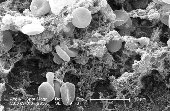 the astra-zeneca blood clots