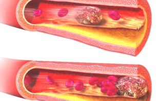 world health dismisses astrazeneca clots