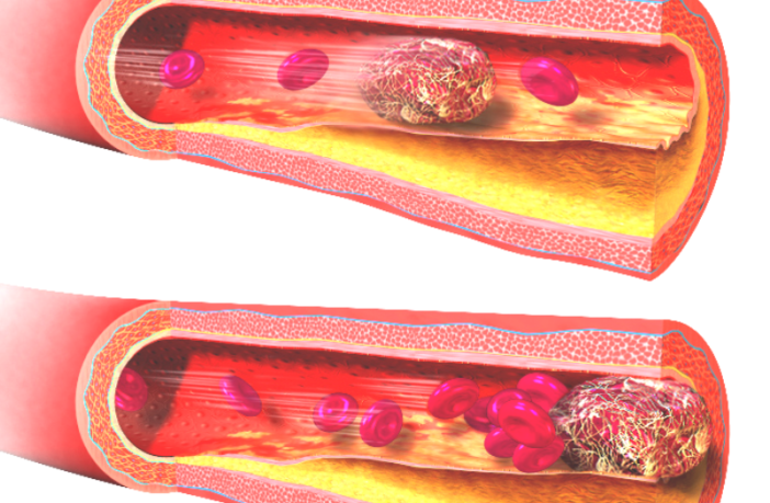 world health dismisses astrazeneca clots