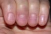 the truth about covid red nail symptoms