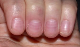 the truth about covid red nail symptoms