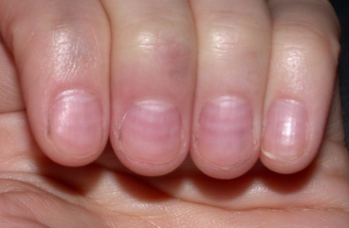the truth about covid red nail symptoms