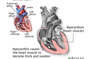 myocarditis and pericarditis after covid