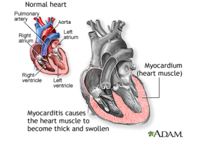 myocarditis and pericarditis after covid