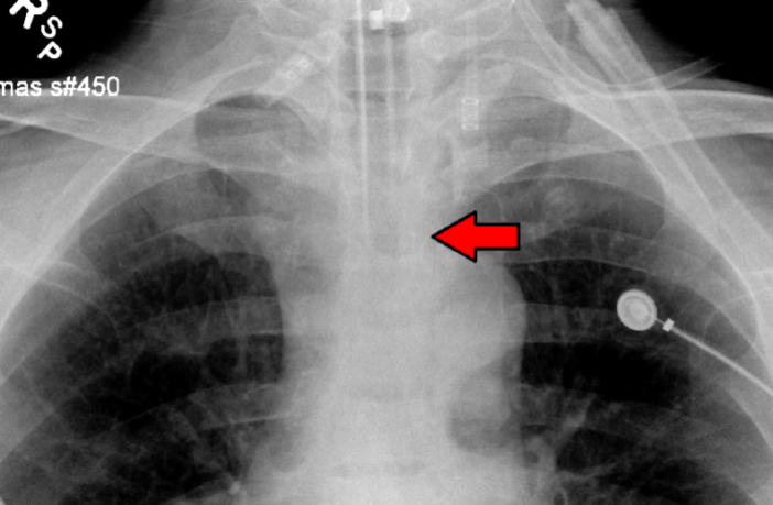 delta or vaccination