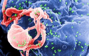 how covid-19 affects people with hiv/aids
