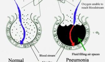 long covid stole the life joy of a survivor