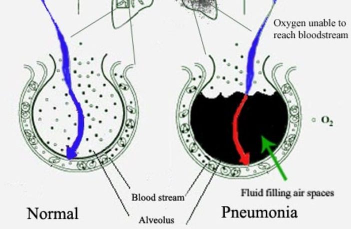 long covid stole the life joy of a survivor