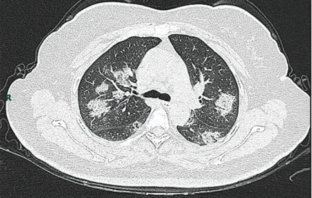 how to protect yourself against severe covid