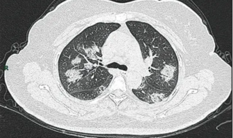 how to protect yourself against severe covid