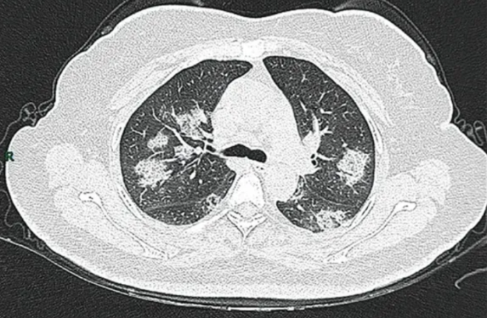 how to protect yourself against severe covid