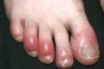 covid big toe a result of immune response
