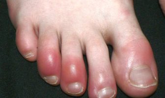 covid big toe a result of immune response