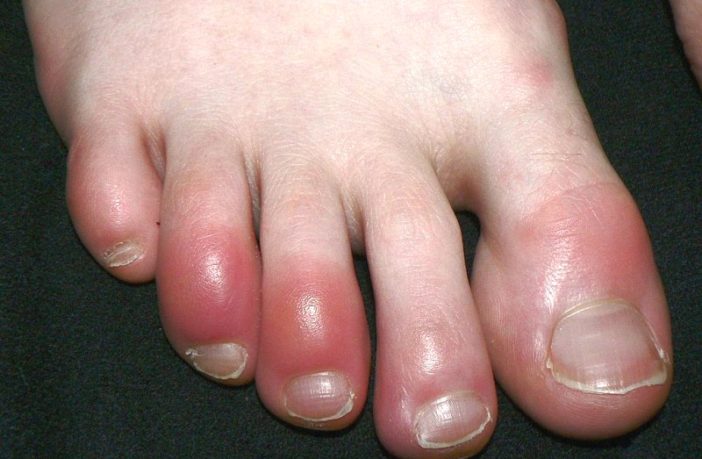 covid big toe a result of immune response