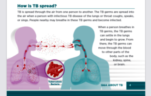 covid and tuberculosis