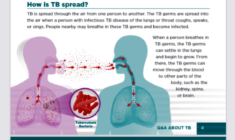 covid and tuberculosis