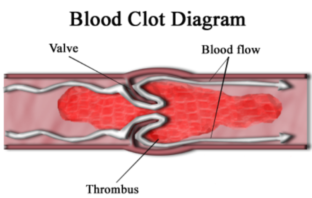 astrazeneca vaccine blood clot risk