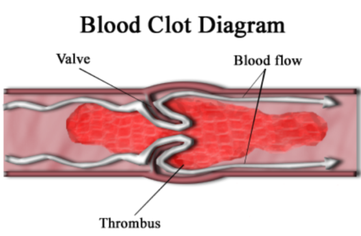 astrazeneca vaccine blood clot risk