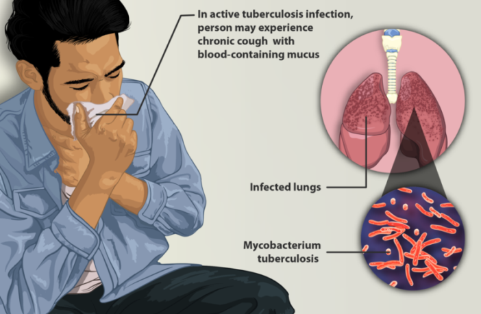 tuberculosis stepped aside for covid