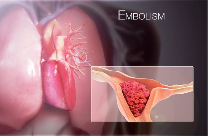 more risk of serious blood clots after covid