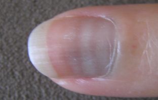 unusual covid-19 symptoms