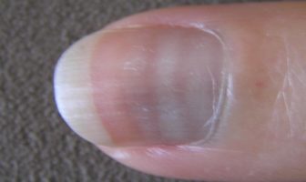 unusual covid-19 symptoms