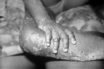 monkeypox is not another coronavirus