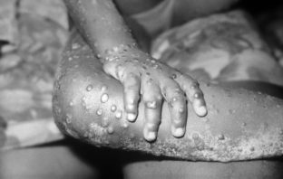 monkeypox is not another coronavirus