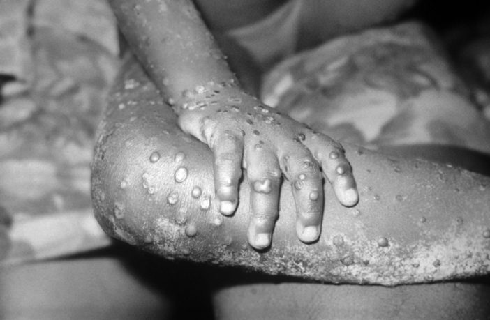 monkeypox is not another coronavirus