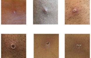 how monkeypox virus is different from covid