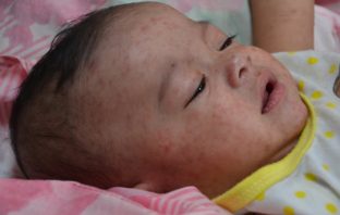 europe faces a higher risk of measles cases