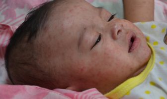 europe faces a higher risk of measles cases