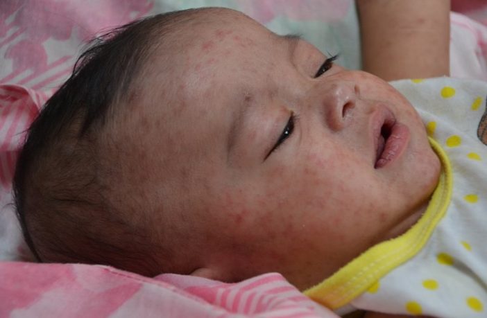 europe faces a higher risk of measles cases