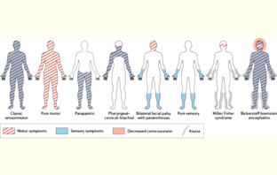 rare case of fatal guillain-barre syndrome