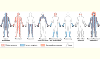 rare case of fatal guillain-barre syndrome