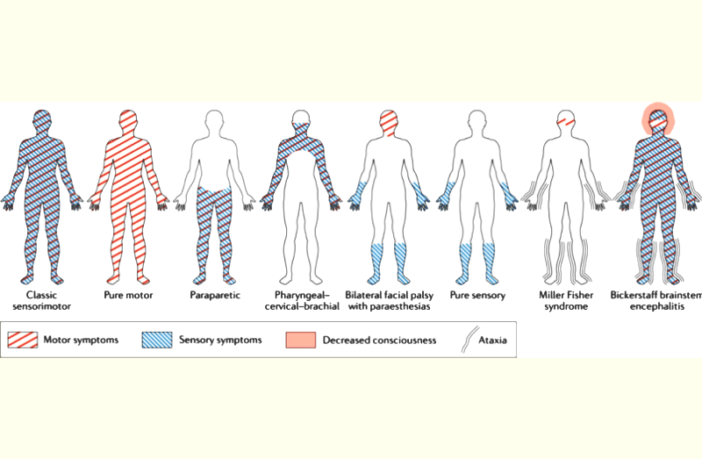 rare case of fatal guillain-barre syndrome