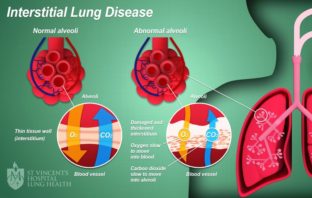 covid rheumatoid arthritis