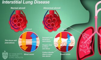 covid rheumatoid arthritis