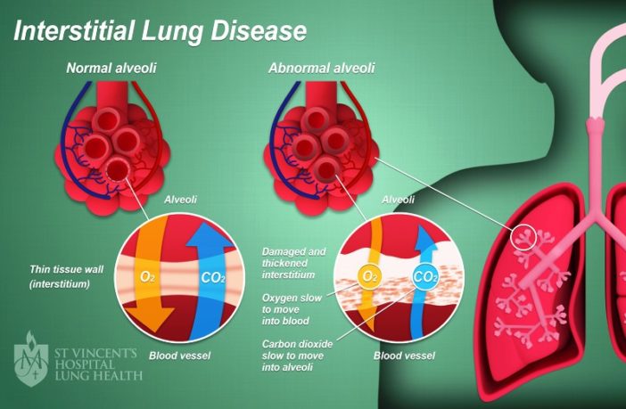 covid rheumatoid arthritis