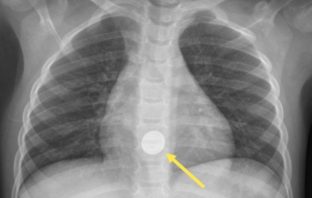 know your child swallowed a battery